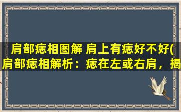 肩部痣相图解 肩上有痣好不好(肩部痣相解析：痣在左或右肩，揭示健康好坏，爱情婚姻趋向，财富运势，您知道吗？)